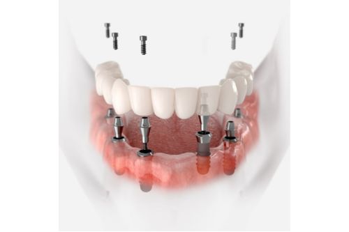 All-on-4 Implants